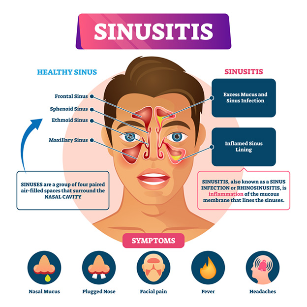 Can Sinus Pressure Cause Neck Pain